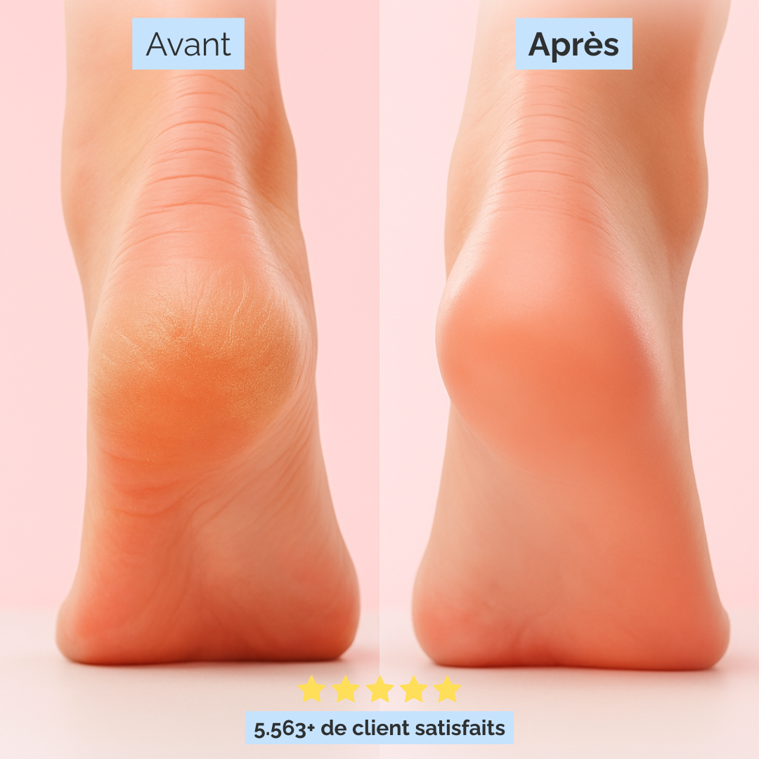 Rolorau™ - Fini la peau sèche, découvrez des pieds doux comme du velours